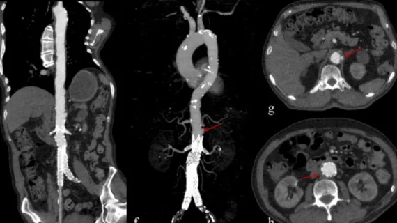 Deep learning recons reduce contrast and radiation doses in aortic CTA