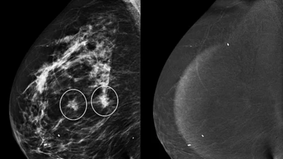 Non-enhancing asymmetries on contrast-enhanced mammography