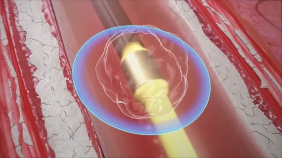 The use of intravascular lithotripsy (IVL) during percutaneous coronary intervention (PCI) is still safe and effective when patients present with calcified nodules (CNs), according to new long-term data published in EuroIntervention.[1] Researchers compared outcomes from patients with and without CNs, highlighting key similarities in stent expansion and luminal gain.
