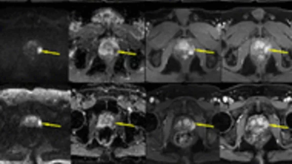 Simulated MR images could eliminate the need for contrast in prostate scans.