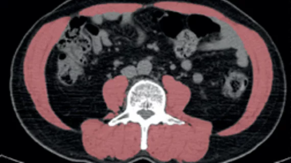 Obesity can improve lung cancer outcomes, but only if skeletal muscle quality is maintained