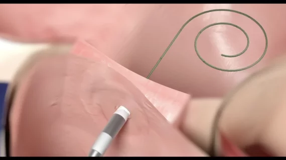Alleviant Medical, a Texas-based medical device company, has received the FDA’s breakthrough device designation and an investigational device exemption (IDE) for its new atrial shunt that treats heart failure without leaving a permanent implant in the body. 