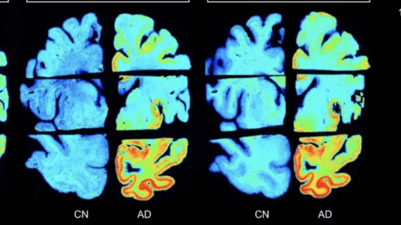 New radiotracers outperform FDA-approved agent for detection of tau tangles.