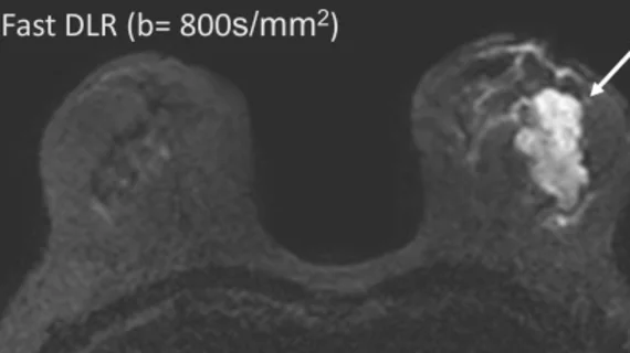 Deep learning reconstruction improves breast MRI quality