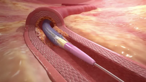 Prevail DCB Medtronic