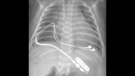 Chest X ray in AP projection of a neonate with an epicardial left ventricular bipolar pacing lead connected to a pediatric implantable pulse generator (IPG) in the left upper abdominal pocket. Image and caption courtesy of the American Heart Association and Circulation: Arrhythmia and Electrophysiology.