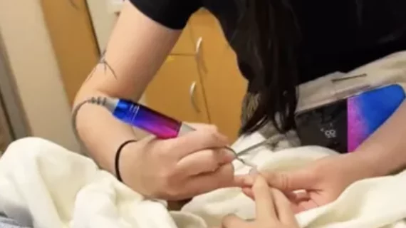 Cat eye manicure an MRI safety risk
