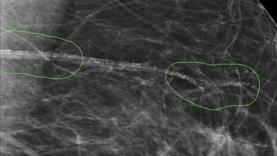 AI not currently safe to use as a standalone reader in breast cancer screenings.