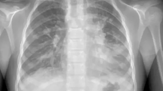 What mycoplasma pneumonia looks like on imaging.