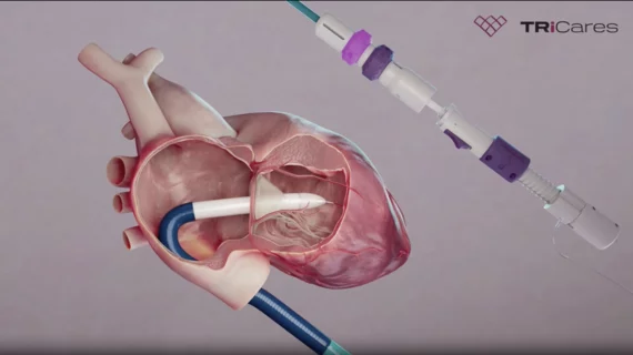 Topaz transcatheter tricuspid valve replacement (TTVR) system TriCares