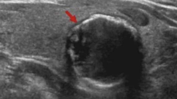 Predictive model helps identify malignancy in thyroid nodules.