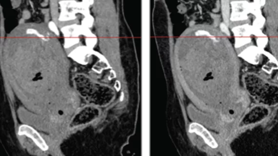 CT identifies postpartum hemorrhage resistant to treatment