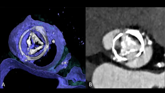 CT imaging showing structural valve deterioration 