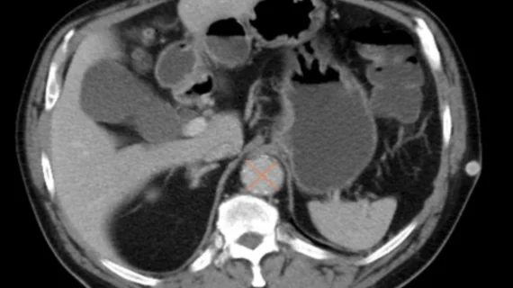 AI algorithm spots AAA on abdominal CT scan