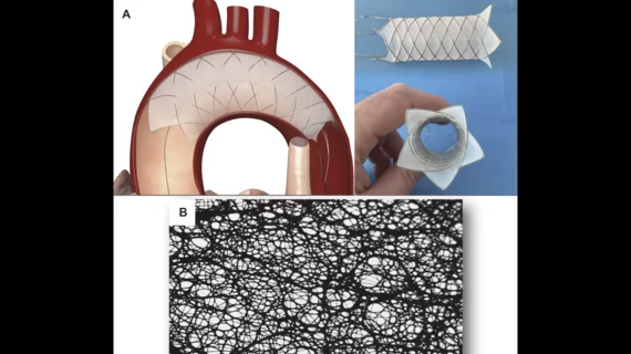 EnCompass F2 device from Nevada-based EnCompass Technologies. (A) Aortic arch deflector composed of a cylindrical nitinol frame that covers all three vessels supplying blood flow to the brain while allowing passage of the transcatheter aortic valve replacement system through its center. (B) It features an electrospun filter with very small pore size (30 μm average). Images/caption courtesy of JACC: Case Reports and George et al. 
