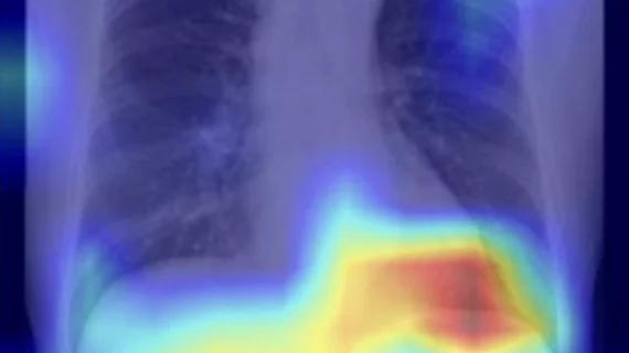AI spots fatty liver on chest x-rays.
