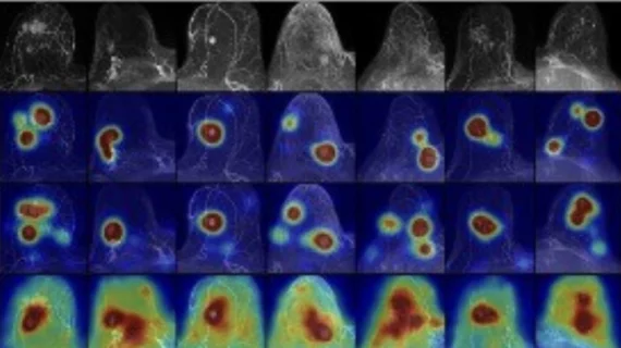 Explainable AI spots more cancer on breast MRI