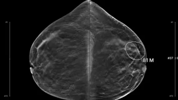Lunit AI detects interval breast cancer missed by radiologists