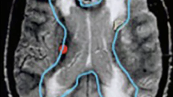 MRI biomarkers predict cognitive impairment post-stroke