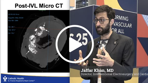 Video interview with Jaffar Khan, MD, St. Francis Heart Center, explaining tests using IVL in mitral annular calcification (MAC).