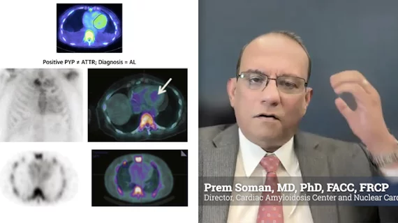 Prem Soman, MD, PhD, FACC, FRCP, past president of the American Society of Nuclear Cardiology (ASNC), the Richard S. Caligiuri Endowed Chair in Amyloidosis and Heart Failure, director of the Cardiac Amyloidosis Center, director of nuclear cardiology, and a professor of medicine, University of Pittsburgh Medical Center (UPMC) Heart and Vascular Institute. He is presenting the keynote Mario Verani Memorial Lecture at ASNC 2025, where he will discuss transforming cardiac amyloidosis care.