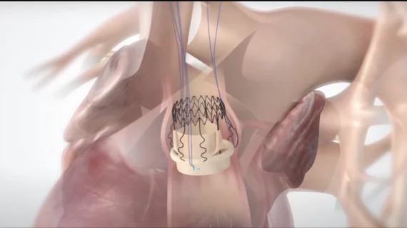 Corcym’s Perceval Plus aortic heart valve 
