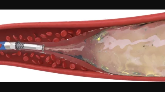 Instylla Embrace Hydrogel Embolic System