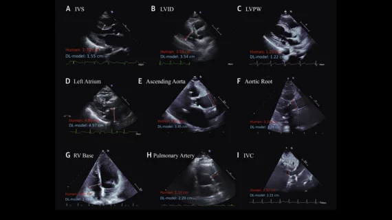 Cardiologists have developed an open-source artificial intelligence (AI) model capable of accurately evaluating a long list of measurements on echocardiography results. The group detailed the development and validation of that model in the Journal of the American College of Cardiology.