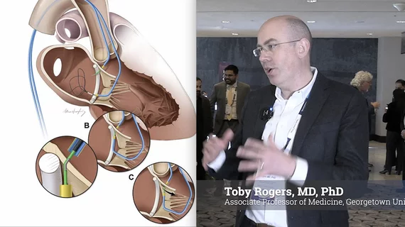 Toby Rogers, MD, PhD, associate professor of medicine Georgetown University, and interventional cardiologist at MedStar Heart and Vascular Institute Structural Heart Disease program, explains how the transcatheter electrosurgical procedures for transcaval access, SESAME, LAMPOON and BASILICA has helped large numbers of patients receive transcatheter heart valves who otherwise would have been disqualified due to anatomical issues. 