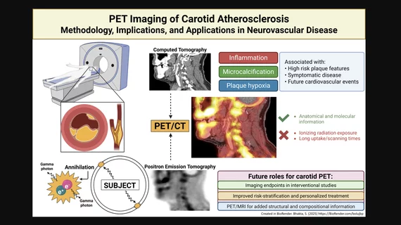 Positron emission tomography (PET) nuclear imaging has seen rapid expansion in cardiology and oncology due to its improve accuracy over SPECT and its ability to expand into new areas of cardiovascular imaging. A new review in the American Heart Association journal Stroke outlines another possible use of PET to assess carotid artery atherosclerosis for stroke prevention. Figure courtesy Stroke, https://www.ahajournals.org/doi/10.1161/STROKEAHA.125.050399