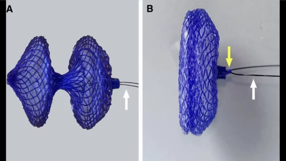 biodegradable PFO closure device