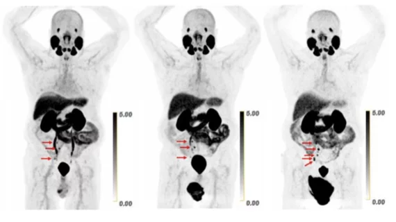 Copper-based radiotracer excels at PSMA imaging