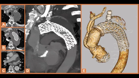 elephant trunk (FET) technique to treat a middle-aged heart patient, sharing their experience in JACC: Case Reports.[1] This is believed to be the first time surgeons have ever employed this particular approach.