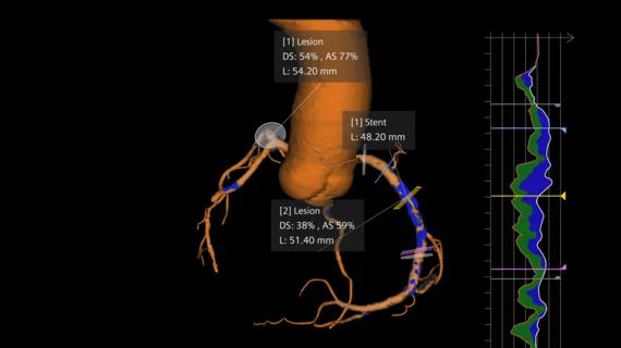 Siemens Healthineers software Syngo.CT Coronary Cockpit 
