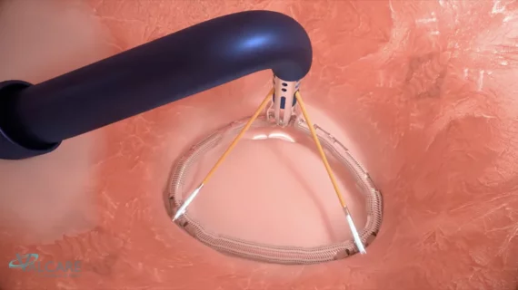 Valcare Medical’s Amend Transseptal System for mitral regurgitation