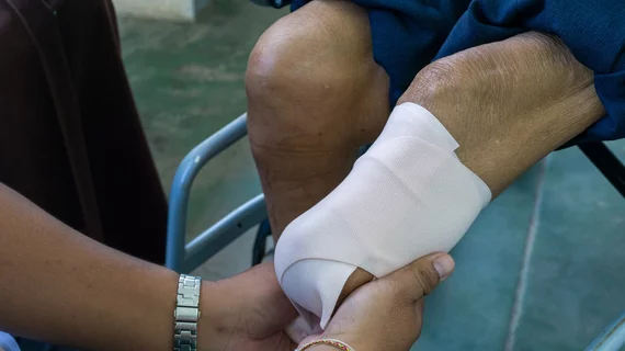 leg amputation below the knee