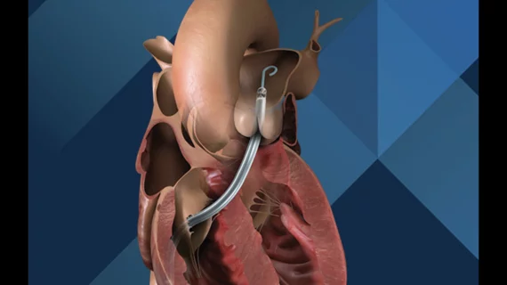 The Impella RP with SmartAssist. Image courtesy of Johnson & Johnson MedTech.