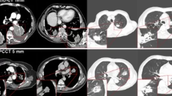 Photon-counting CT scans best conventional CTs for lung cancer follow-up