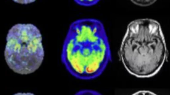 Combining PET and MRI data helps distinguish between LATE and Alzheimer's