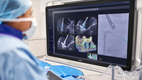 Philips has secured U.S. Food and Drug Administration (FDA) clearance for EchoNavigator R5.0 with DeviceGuide, the company’s artificial intelligence (AI)-enabled software for mitral transcatheter edge-to-edge repair (M-TEER).
