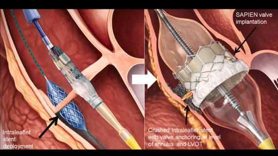 After traversing the aortic cusp with an electrified wire and balloon inflation, a stent is positioned inside the noncoronary cusp and deployed. Immediately after, a transcatheter aortic valve is expanded, and the stent is crushed on the left ventricular outflow tract wall and annulus, while anchored to the aortic valve leaflet.