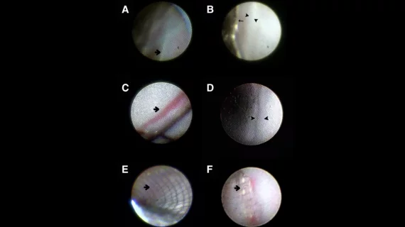 Selection of stent images captured with the MicroAngioscope from Vena Medical. Images courtesy of Kan et al. and Stroke.