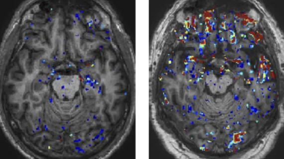 'Leaky' blood brain barrier causes long-term damage years after head injuries