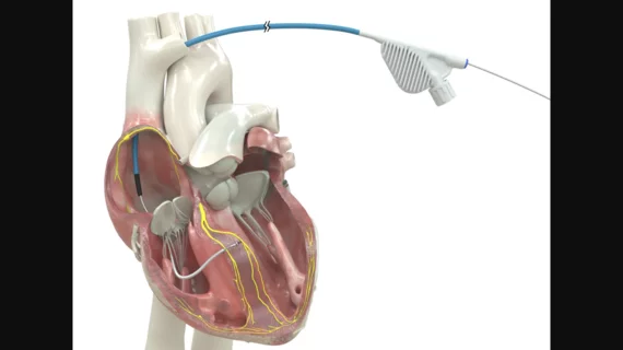 OmniaSecure defibrillation lead approved by FDA for placement in LBB area