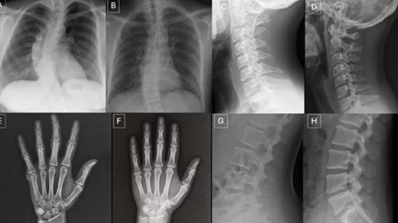 Deepfake X-rays trick radiologists and AI
