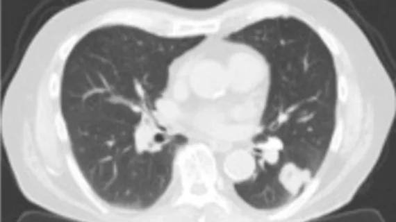 Cryoablation treatment for inoperable non-small cell lung cancer