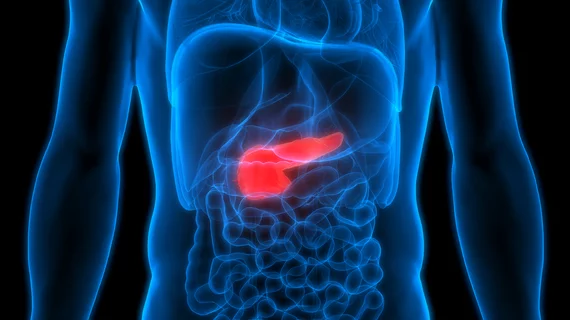 AI helps spot pancreatic cancer over a year before radiologists can