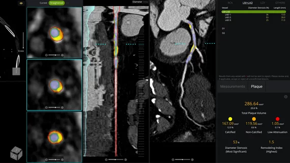 cvi42 | Plaque Circle Cardiovascular Imaging