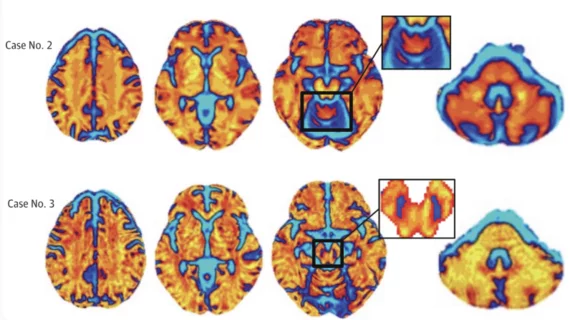 Neuropacs for Parkinsonian syndromes