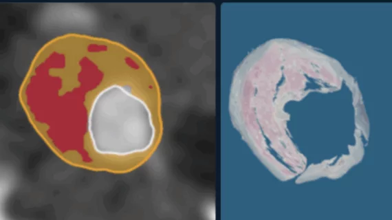 Elucid's new Lesion Analysis Tool now commercially available